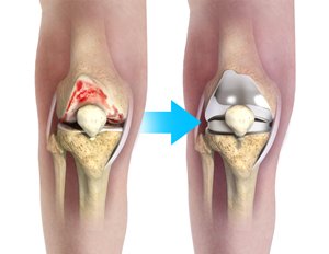Complex Knee Replacement