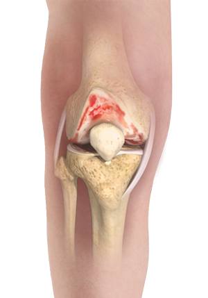 Knee Osteoarthritis