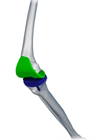 Robotic Assisted Total Knee Replacement