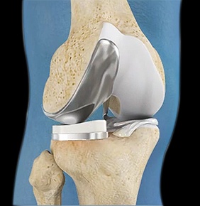 Unicompartmental/Partial Knee Replacement