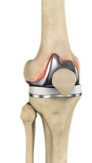Management of Periprosthetic Infection