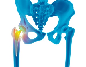 Revision Hip Replacement