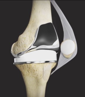 Tricompartmental Knee Replacement