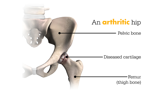 Arthritic Hip Arthritic Hip