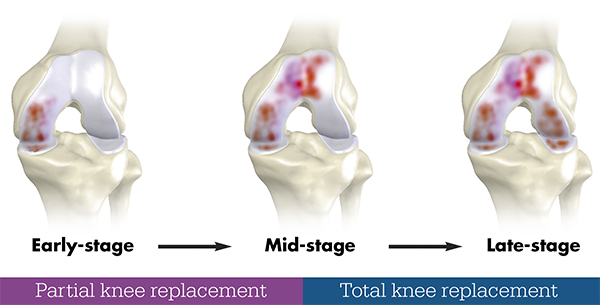 Partial Knee replacement Partial Knee replacement