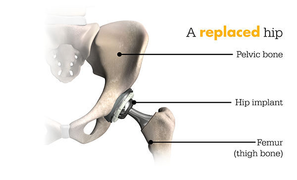 Replaced Hip Replaced Hip