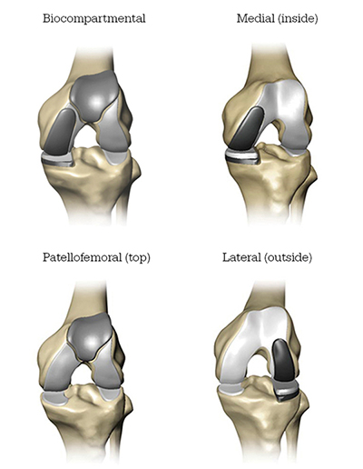 Mako Robotic-Arm Assisted Partial Knee replacement Mako Robotic-Arm Assisted Partial Knee replacement