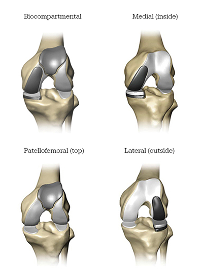 Mako Robotic-Arm Assisted partial knee replacement Mako Robotic-Arm Assisted partial knee replacement
